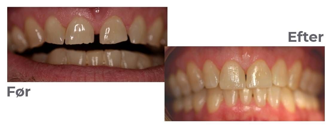 tandsæt før og efter restaurering af tænderne med plast