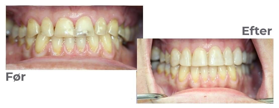 tandsæt før og efter restaurering af tænderne med plast